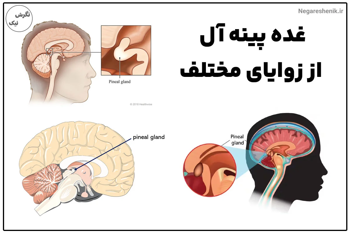 عکس غده پینه آل از زوایای مختلف در مغز